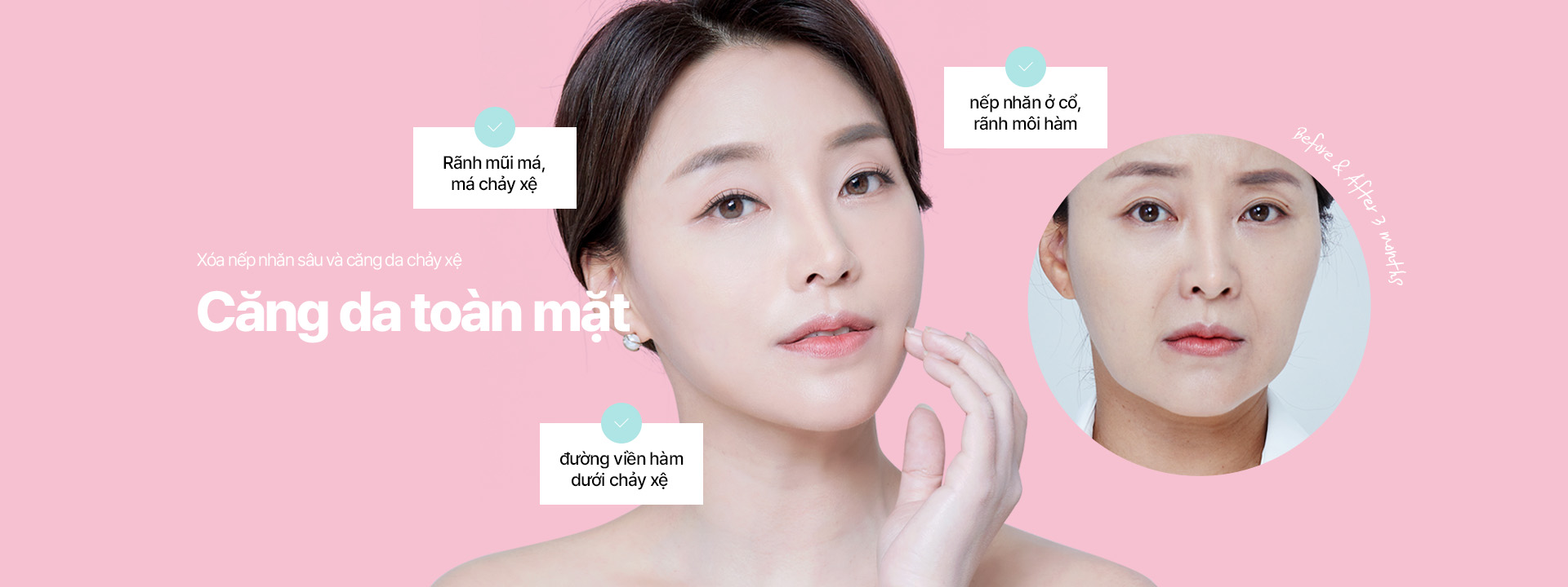 Xóa nếp nhăn sâu và căng da chảy xệ Căng da toàn mặt