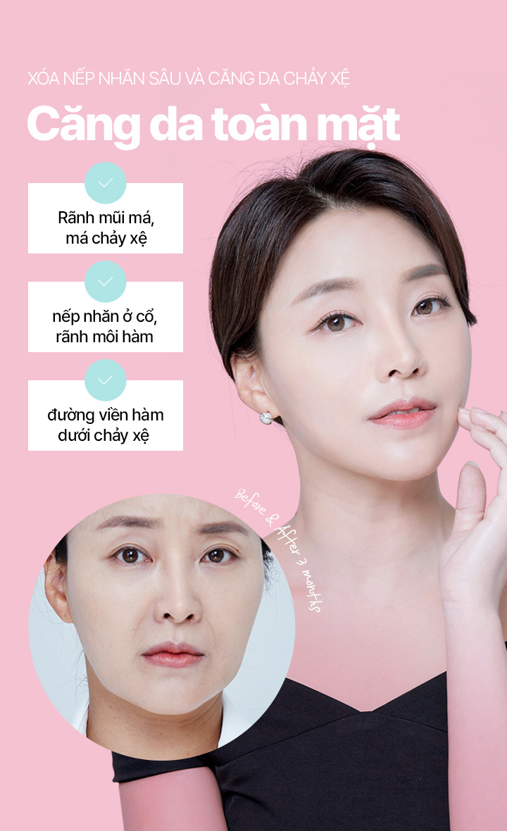 Xóa nếp nhăn sâu và căng da chảy xệ Căng da toàn mặt