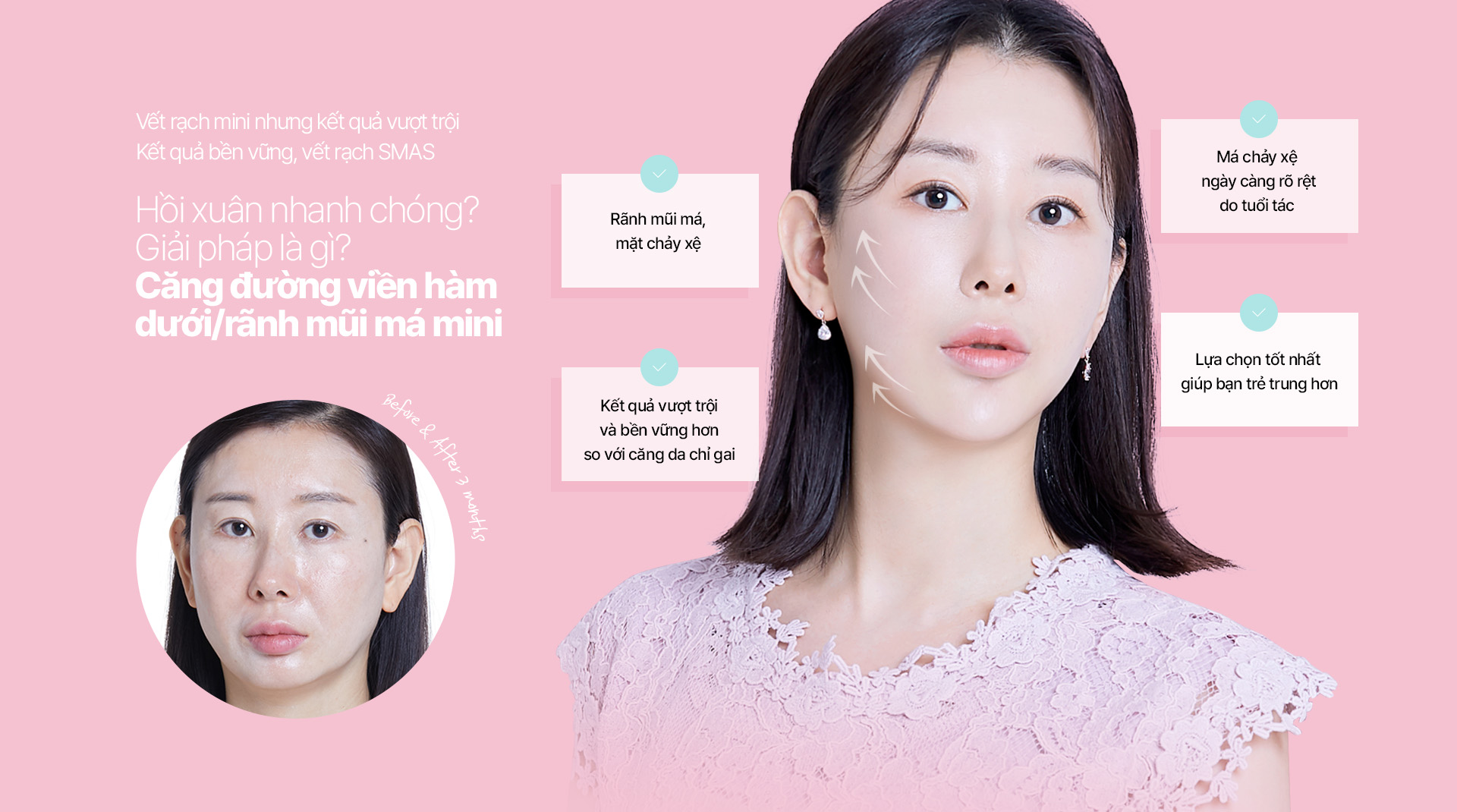 Vết rạch mini nhưng kết quả vượt trội Kết quả bền vững, vết rạch SMAS Hồi xuân nhanh chóng? Giải pháp là gì? Căng đường viền hàm dưới/rãnh mũi má mini
