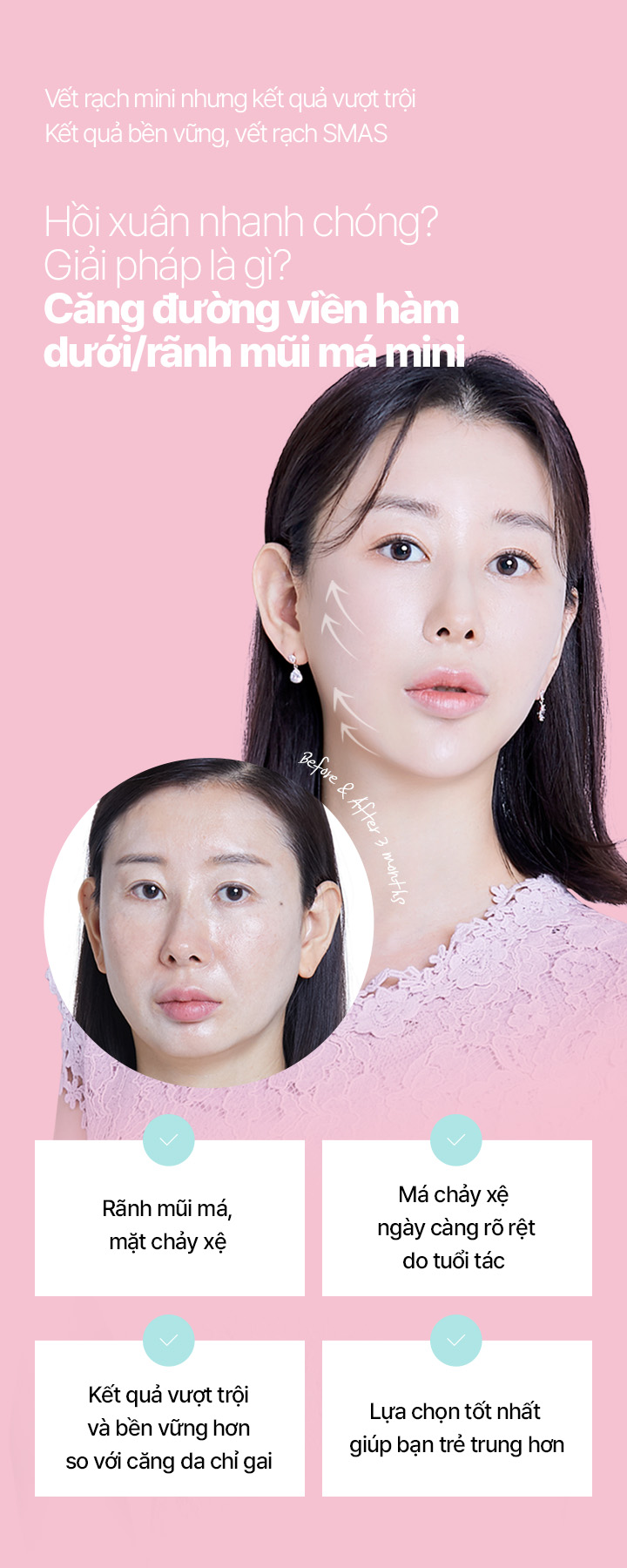 Vết rạch mini nhưng kết quả vượt trội Kết quả bền vững, vết rạch SMAS Hồi xuân nhanh chóng? Giải pháp là gì? Căng đường viền hàm dưới/rãnh mũi má mini