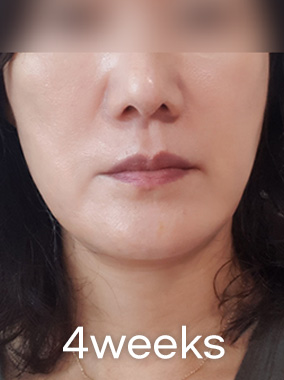 Trẻ hóa da không phẫu thuật Ảnh trước và sau