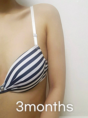 LookFat, chỉ loại bỏ phần mỡ Ảnh trước và sau