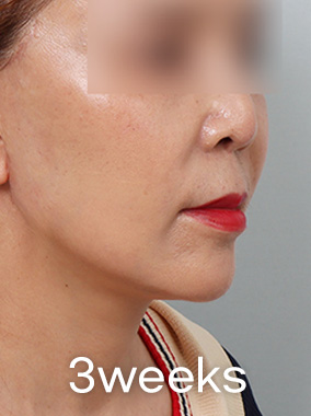 Căng da Mini 4X Ảnh trước và sau