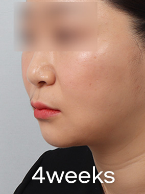 Căng da Mini 4X Ảnh trước và sau