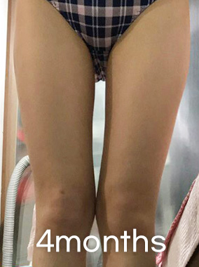 Hút mỡ bắp đùi Ảnh trước và sau