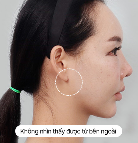 Thử nghiệm về sẹo Căng đường viền hàm dưới mini Sau 10 ngày ngày Ảnh thực tế sau khi tháo chỉ