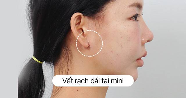 Thử nghiệm về sẹo Căng đường viền hàm dưới mini 24 giờ ngày Ảnh thực tế sau khi tháo chỉ