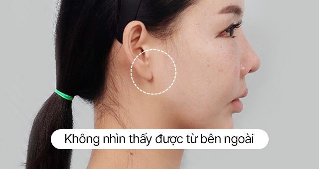 Thử nghiệm về sẹo Căng đường viền hàm dưới mini Sau 10 ngày ngày Ảnh thực tế sau khi tháo chỉ