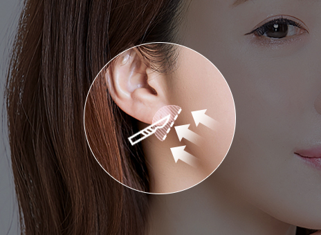 STEP 02 Một phần SMAS được kéo và cố định đồng thời phần da thừa được loại bỏ