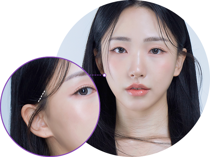 Căng da Mini 4X sẹo ẩn + vết rạch chéo Không cần lo nghĩ về sẹo! Tại Say Yes, chúng tôi tạo vết rạch nhỏ chỉ dài 1cm từ chân tóc nhằm hạn chế sẹo và rụng tóc.