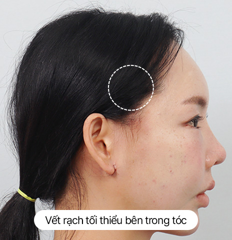 Thử nghiệm về sẹo Hình ảnh căng da trán mini 24 giờ ngày Ảnh thực tế sau khi tháo chỉ