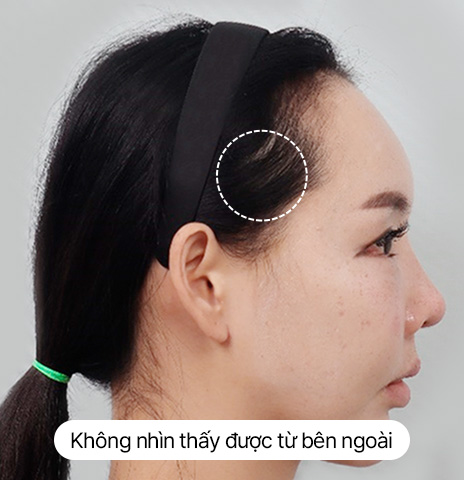 Thử nghiệm về sẹo Hình ảnh căng da trán mini Sau 10 ngày Ảnh thực tế sau khi tháo chỉ