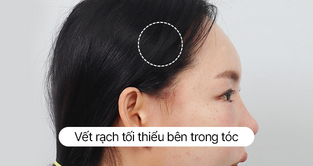 Thử nghiệm về sẹo Hình ảnh căng da trán mini 24 giờ ngày Ảnh thực tế sau khi tháo chỉ