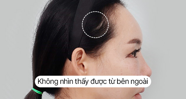 Thử nghiệm về sẹo Hình ảnh căng da trán mini Sau 10 ngày Ảnh thực tế sau khi tháo chỉ