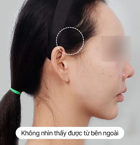 Thử nghiệm về sẹo Căng rãnh mũi má mini 4X Sau 10 ngày Ảnh thực tế sau khi tháo chỉ