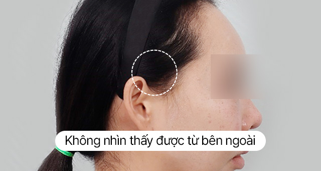 Thử nghiệm về sẹo Căng rãnh mũi má mini 4X Sau 10 ngày Ảnh thực tế sau khi tháo chỉ