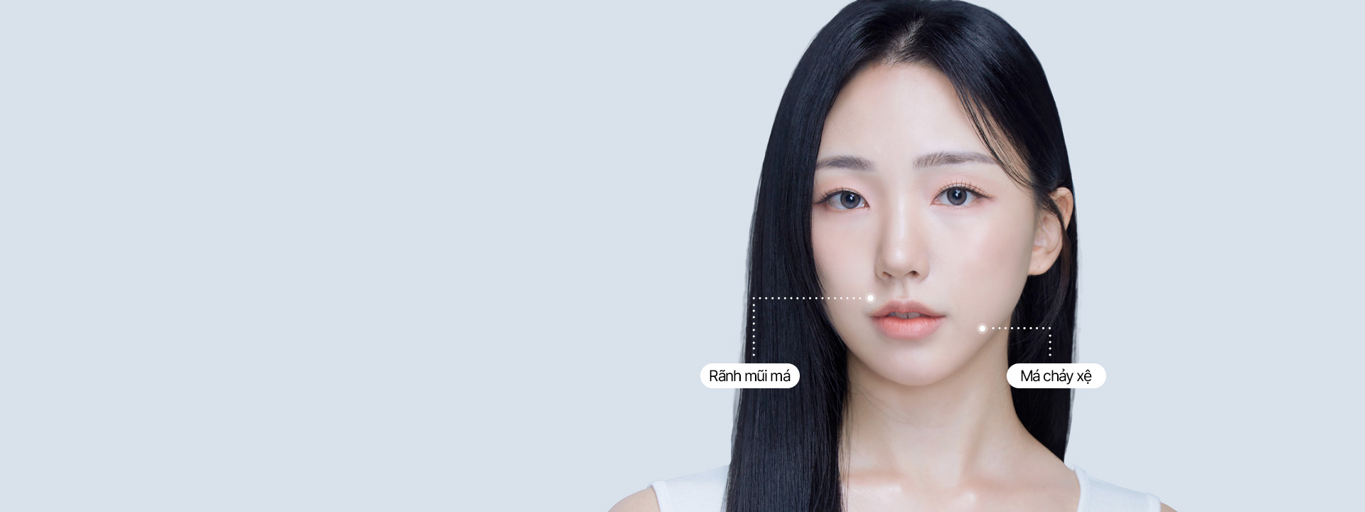 Căng rãnh mũi má mini 4X 피부 노화로 생긴 Rãnh mũi má과 처진Má을 끌어올려 30분만에 얼굴 나이 리셋! 세이예스 미니리프팅은 겉 피부 뿐 아니라 지방 아래 SMAS까지 리프팅실로 한번 더 수직으로 고정시켜 효과 UP!