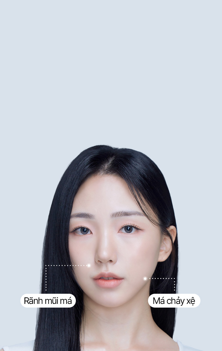 Căng rãnh mũi má mini 4X 피부 노화로 생긴 Rãnh mũi má과 처진Má을 끌어올려 30분만에 얼굴 나이 리셋! 세이예스 미니리프팅은 겉 피부 뿐 아니라 지방 아래 SMAS까지 리프팅실로 한번 더 수직으로 고정시켜 효과 UP!