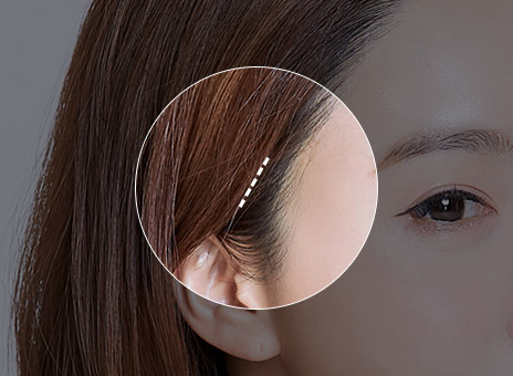 STEP 01 Chỉ rạch tối thiểu ở phần da đầu (1~2 cm)