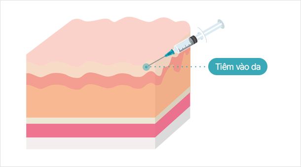 Botox được tiêm vào da, không phải vào cơ Giảm nhăn và tấy đỏ, cải thiện cấu trúc da, se khít lỗ chân lông và nhiều tác dụng khác