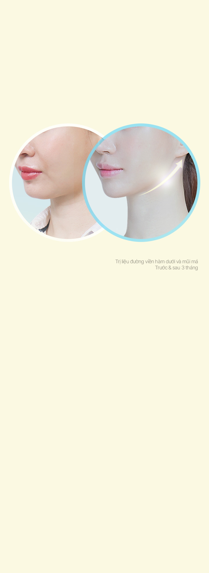 Muốn tận hưởng hiệu quả nâng cơ mặt bằng thủ thuật đơn giản hơn? Chúng tôi xin giới thiệu Căng da Power MINT cho tự tin khoe dáng!